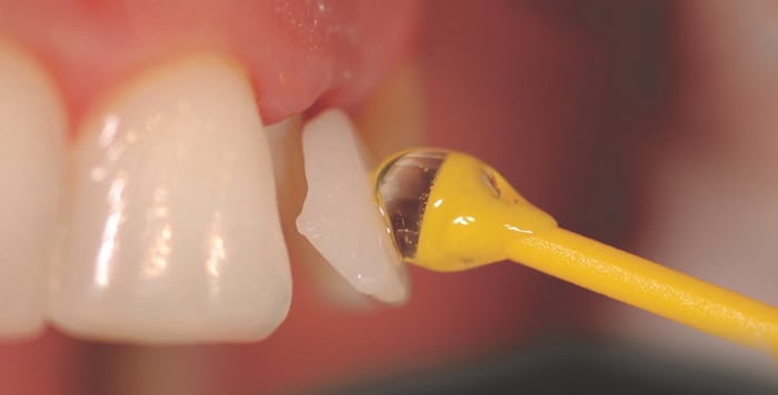 Demystifying Dental Adhesives and Cements Virtual Workshop – When do I use what?