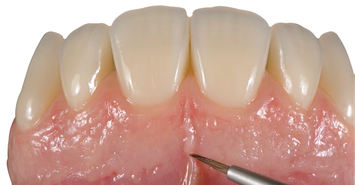 Funktionelle und ästhetische abnehmbare Prothetik mit BPS