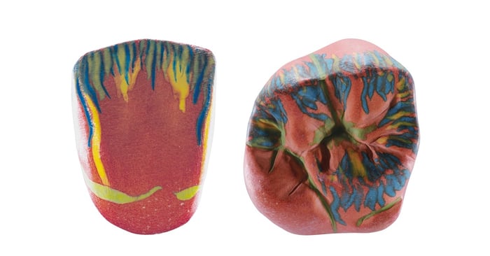 The best and the worst indications for zirconia