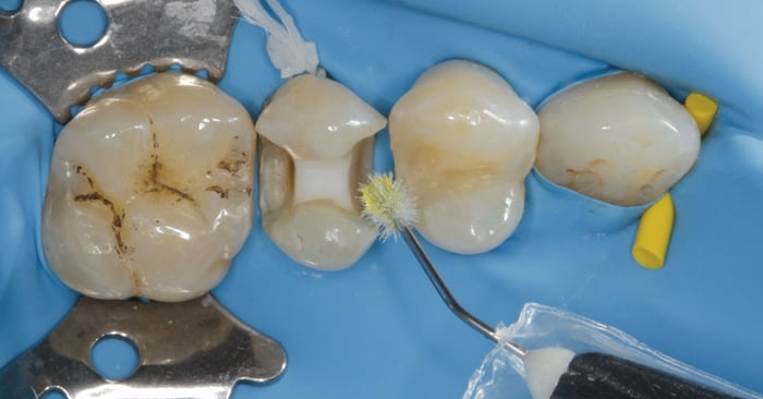 Streamlining bonding procedures