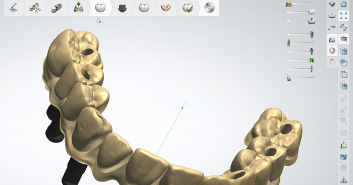 Dental System – Designing of a full arch implant bridge with gingiva
