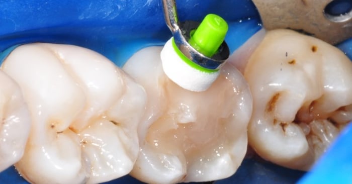 Create direct posterior composite restorations - at speed of light !