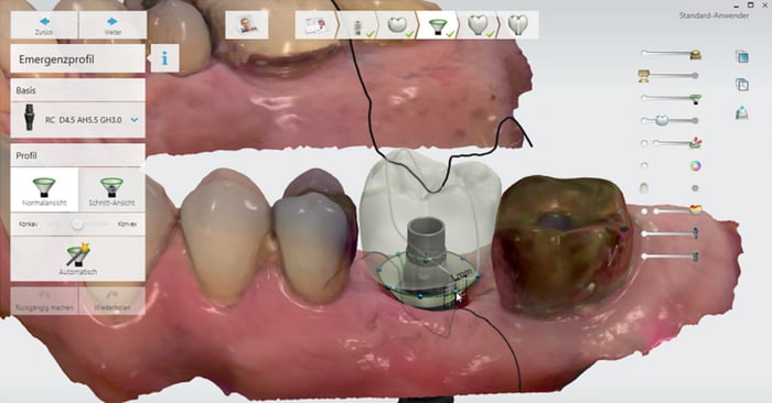 TRIOS 4 TDS – Abutment design: workflow and handling