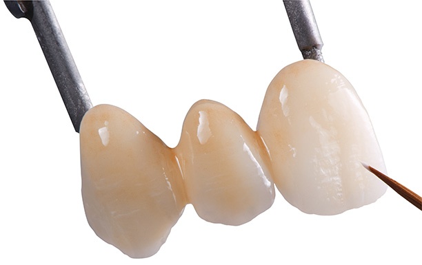 How to Avoid Poor Glaze Consistency to Guarantee Better Restorations