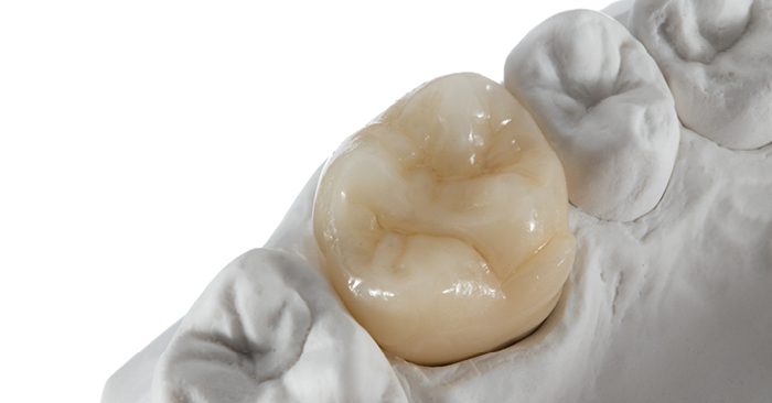 A winning formula for crafting customized restorations