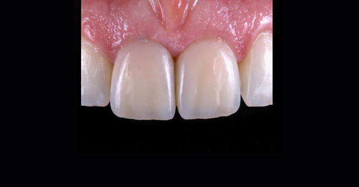 Are Composite Restorations a Perfect Solution for a Post-COVID Time?
