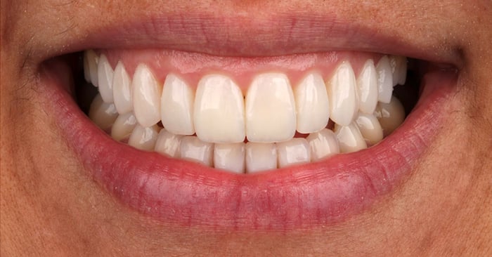 Dental System – Designing of a full arch implant bridge with gingiva
