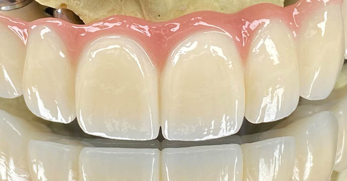 IPS e.max ZirCAD Prime brings back the artistry in full-contour zirconia