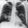 causes of lung cancer x-ray