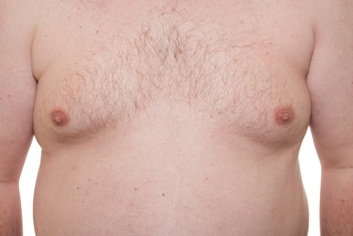 Gynaecomastia (Male breasts, Man boobs) : Causes and Treatment