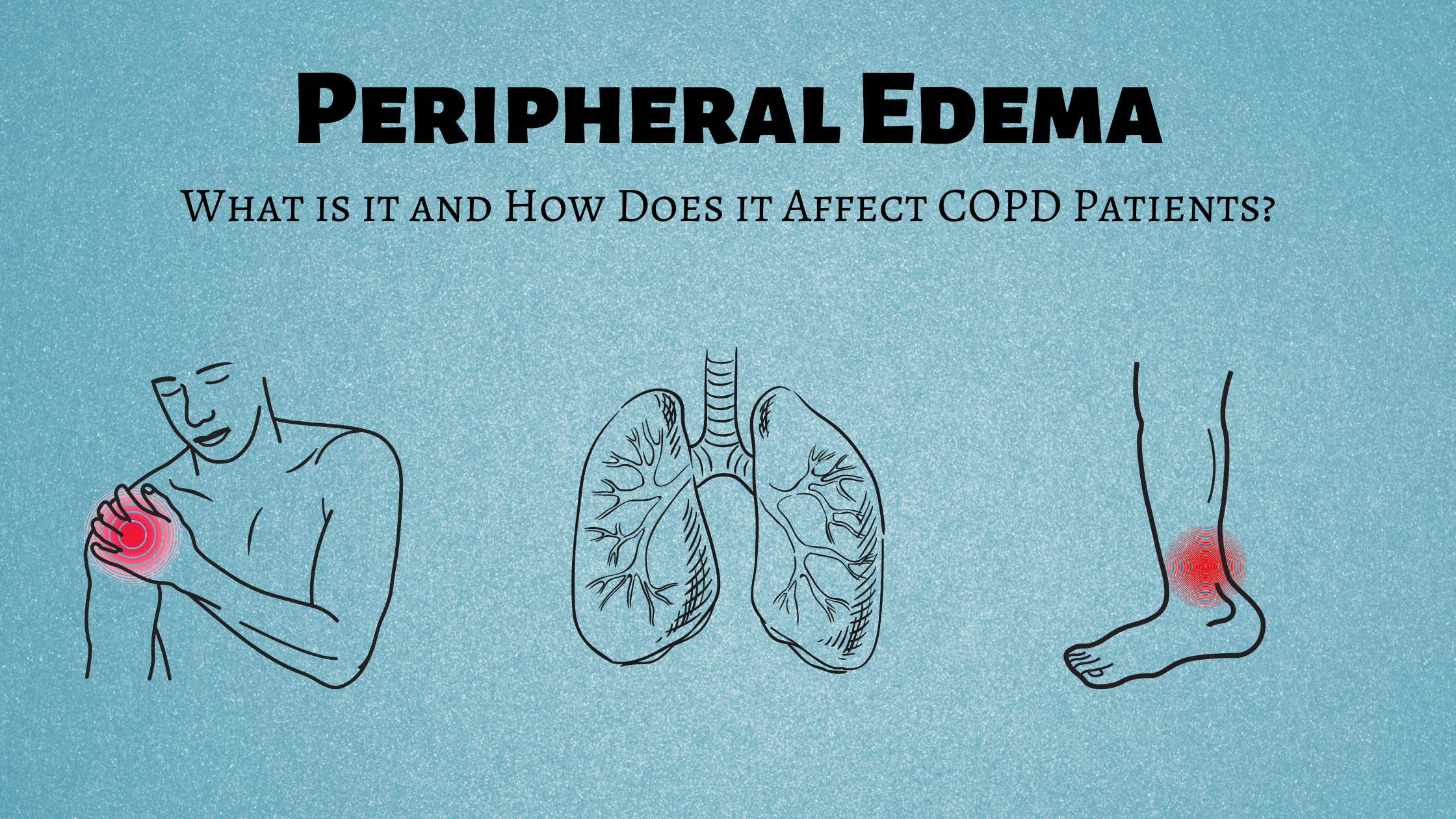 Peripheral Edema: What is it and How Does it Affect COPD Patients?
