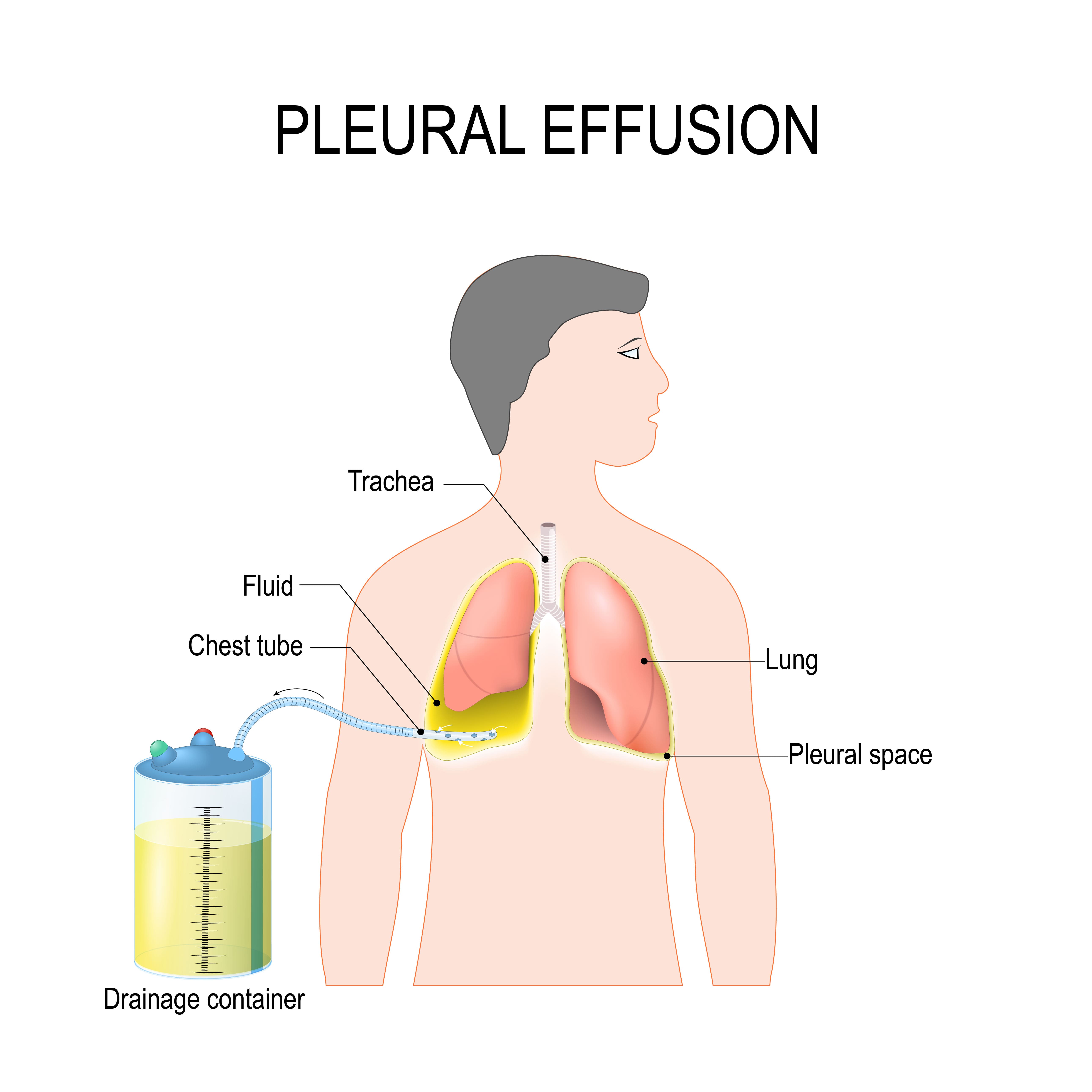 Pleural effusion