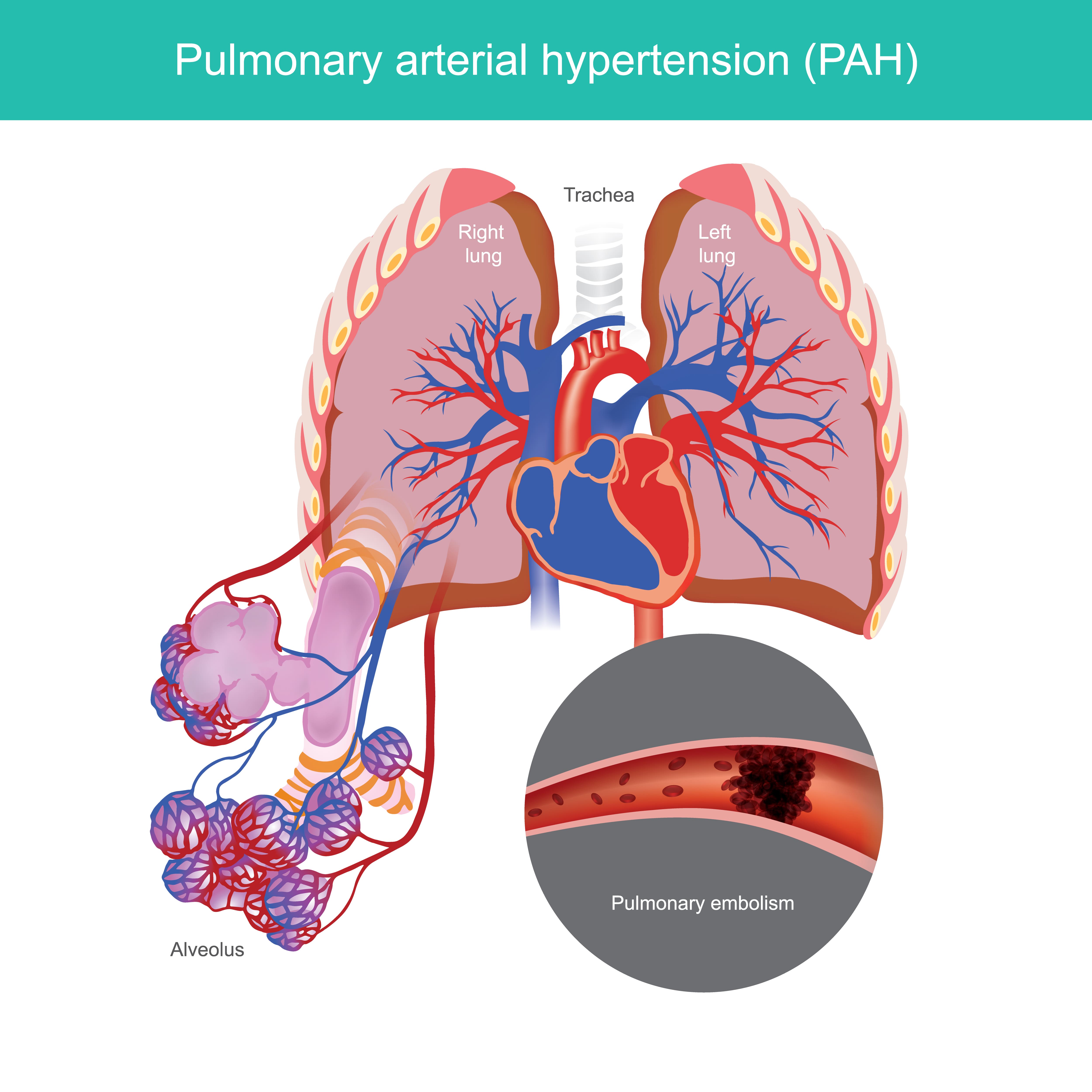 pulmonary arterial hypertension (PAH)