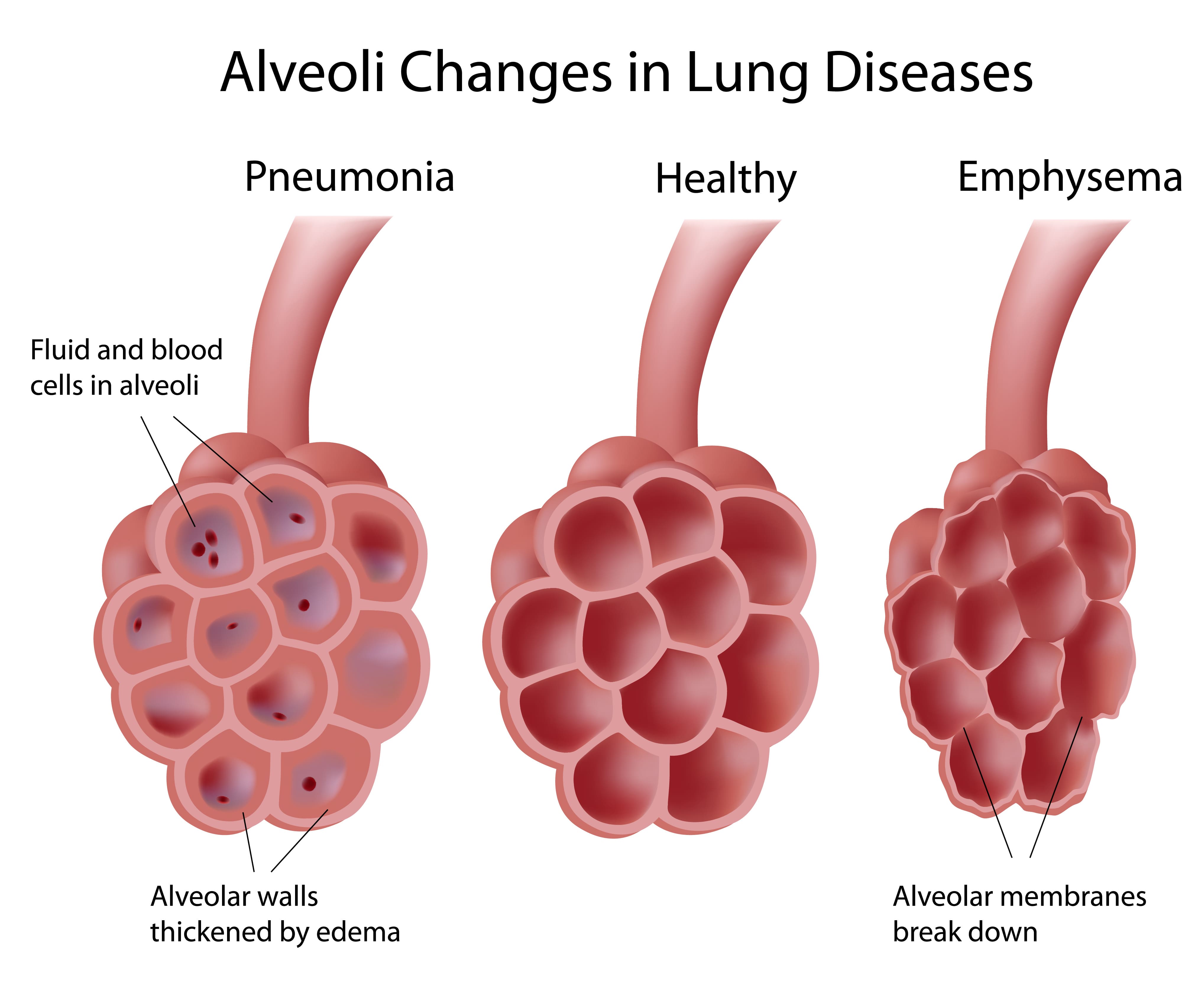 Emphysema Symptoms Stages Pulmonary Hypertension Symptoms Causes 