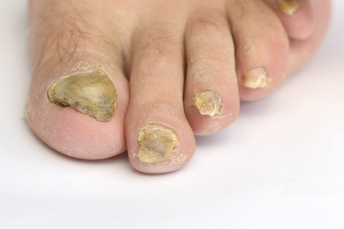 Toe Talk: Fighting Fungus | Ugly truths, lingering culprits and  non-invasive testing