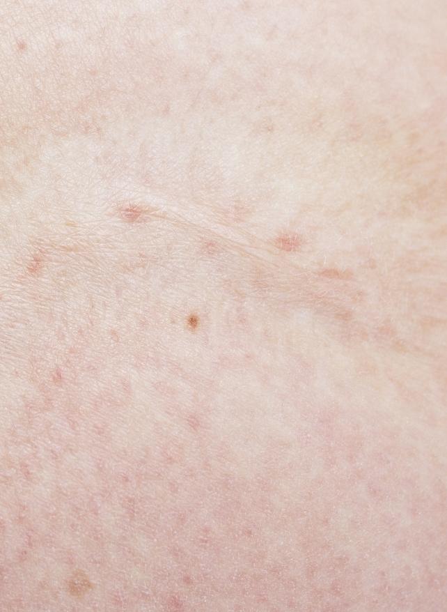 Skin cancer treatments