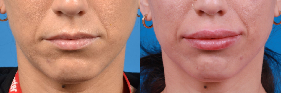 LIPS - BEFORE AND AFTER - Vista Clinic Melbourne