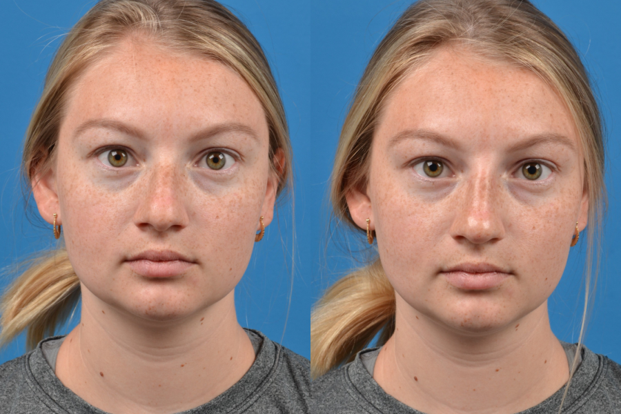 liquid rhinoplasty long island