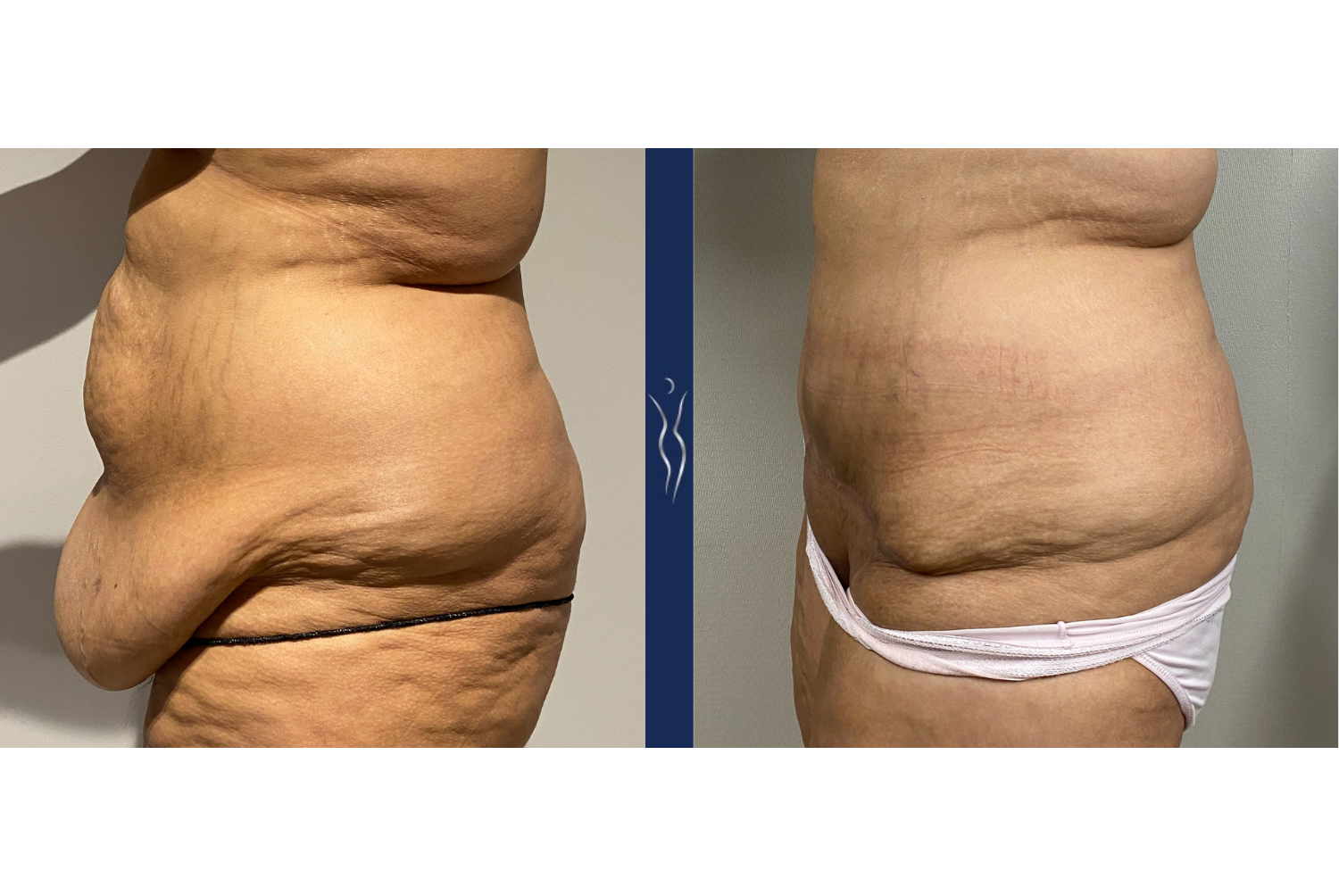 Panniculectomy Vs. Abdominoplasty (Tummy Tuck): Understanding the  Difference